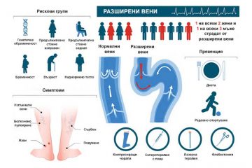 Разширени вени – топ 5 причини, симптоми и усложнения | Ентан